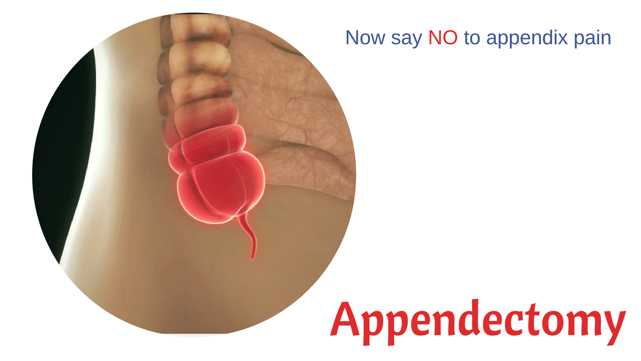 Appendix Surgery Cost In Bangalore