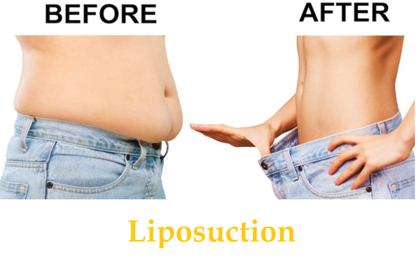 Fat Removal Surgery Cost In Bangalore